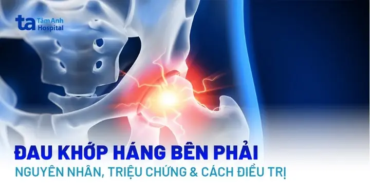 Bà Bầu Bị Đau Khớp Háng Bên Trái