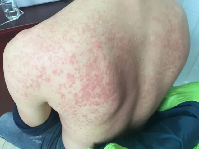 Bà Bầu Bị Dị Ứng Thời Tiết Phải Làm Sao