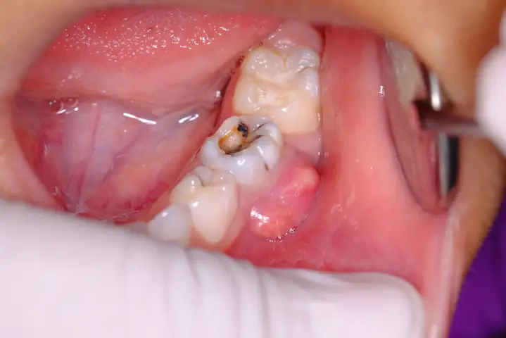 Bà Bầu Bị Hôi Miệng Phải Làm Sao