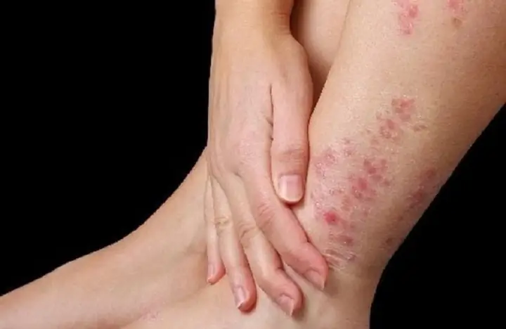 Bà Bầu Bị Nổi Mẩn Ngứa Ở Chân