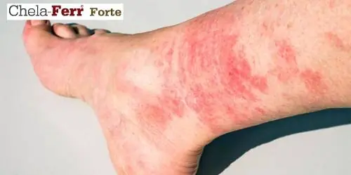 Bà Bầu Bị Nổi Mẩn Ngứa Ở Chân