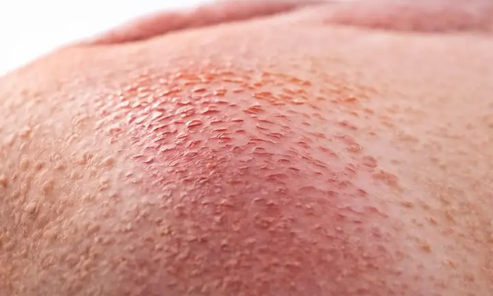Bà Bầu Bị Phù Chân Và Ngứa