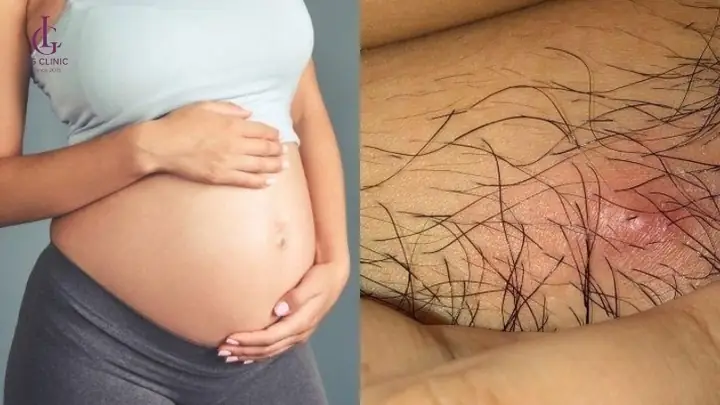 Bà Bầu Có Nên Cắt Lông Vùng Kín