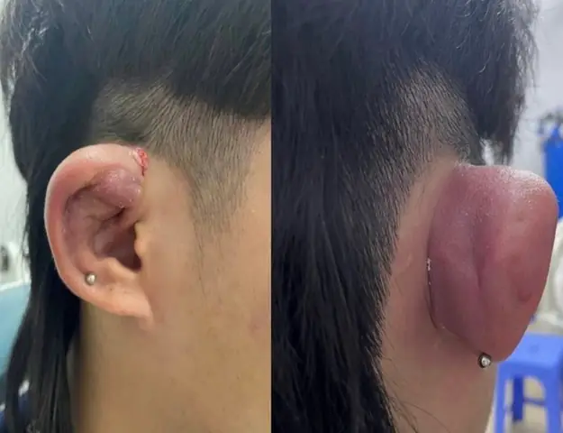 Bấm Lỗ Tai Bệnh Viện Tai Mũi Họng