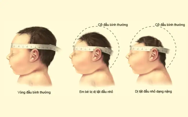 Bảng Đo Vòng Đầu Trẻ Sơ Sinh