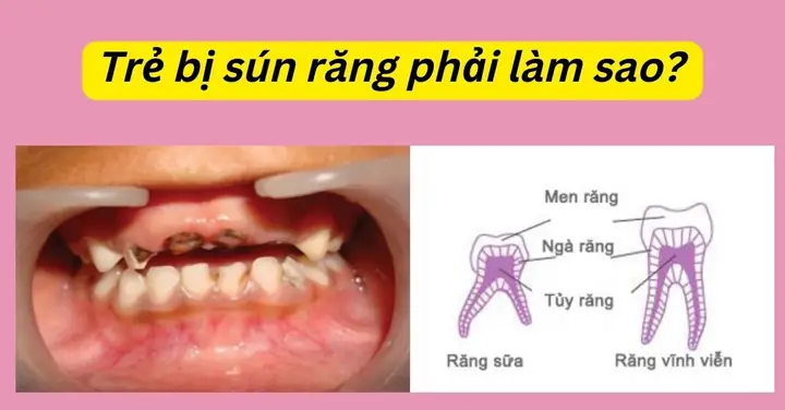 Bé 1 Tuổi Bị Sún Răng