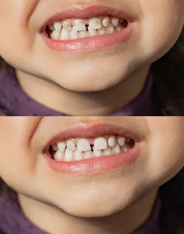 Bé 1 Tuổi Bị Sún Răng