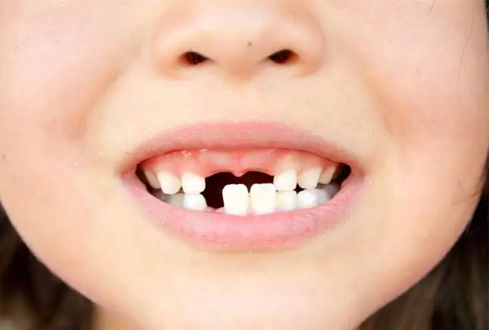 Bé 1 Tuổi Bị Sún Răng