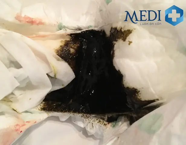 Bé Ăn Dặm Đi Phân Xanh
