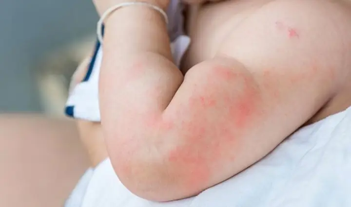 Bé Bị Dị Ứng Sữa Tắm