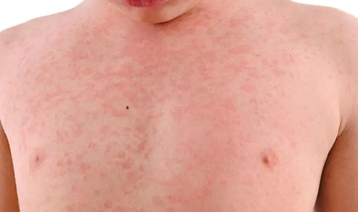 Bé Bị Dị Ứng Sữa Tắm