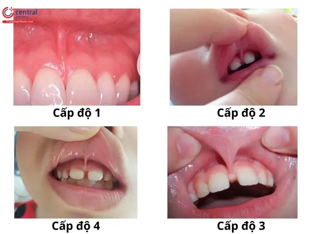 Bé Bị Dính Thắng Môi Trên Bé Bị Dính Thắng Môi Trên