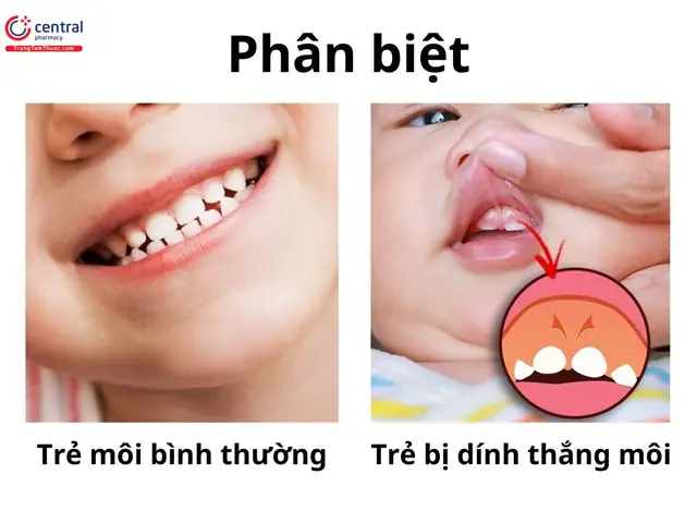 Bé Bị Dính Thắng Môi Trên