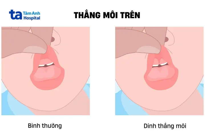 Bé Bị Dính Thắng Môi Trên Bé Bị Dính Thắng Môi Trên