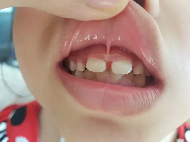 Bé Bị Dính Thắng Môi Trên Bé Bị Dính Thắng Môi Trên