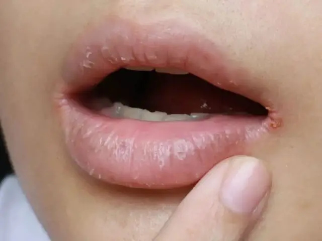 Bé Bị Khô Môi Chảy Máu