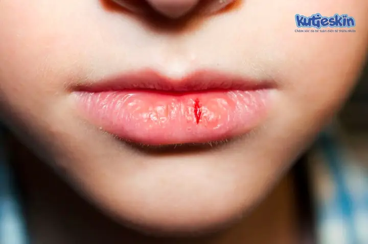 Bé Bị Khô Môi Chảy Máu