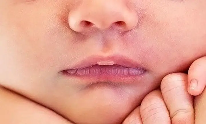 Bé Bị Khô Môi Chảy Máu