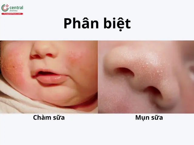 Bé Bị Mụn Sữa Bôi Thuốc Gì