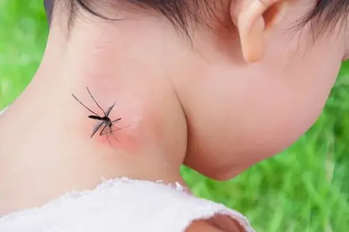 Bé Bị Muỗi Cắn Sưng Đỏ