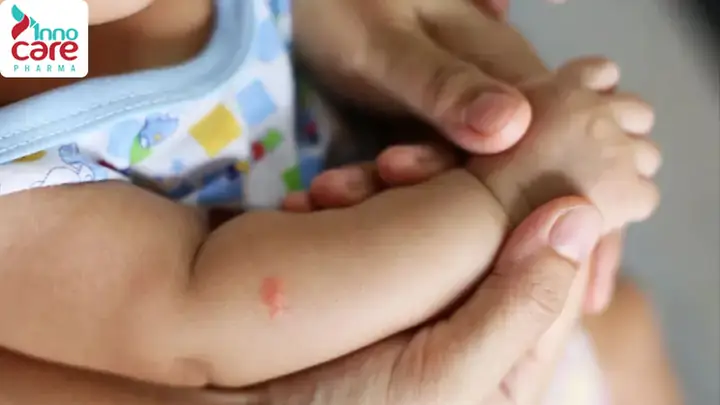 Bé Bị Muỗi Cắn Sưng Đỏ