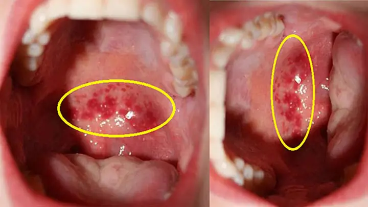 Bé Bị Nổi Hạt Trong Họng
