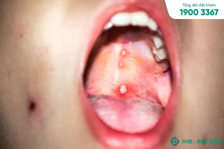 Bé Bị Nổi Hạt Trong Họng