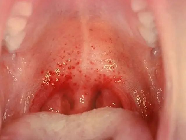 Bé Bị Nổi Hạt Trong Họng