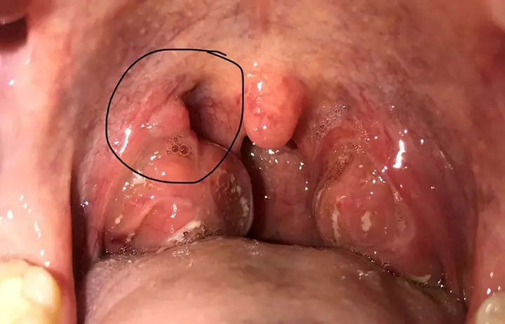 Bé Bị Nổi Hạt Trong Họng