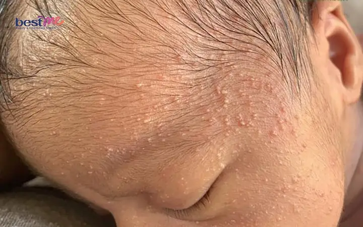 Bé Sơ Sinh Bị Nổi Mụn Nước Trên Đầu