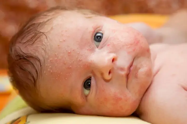 Bé Sơ Sinh Bị Nổi Mụn Nước Trên Đầu
