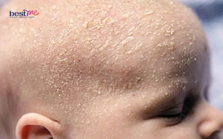 Bé Sơ Sinh Bị Nổi Mụn Nước Trên Đầu