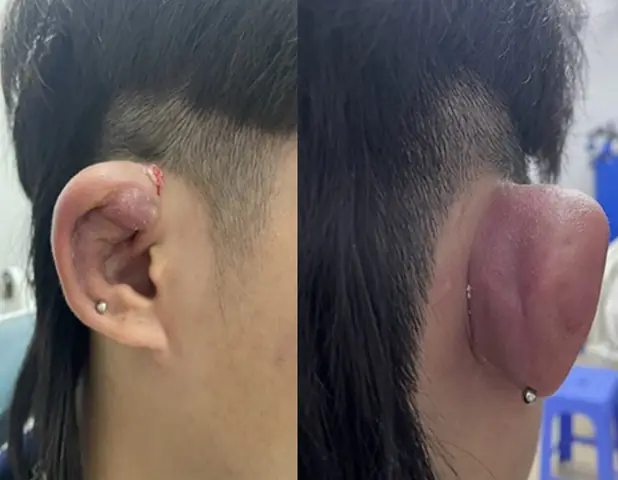 Bệnh Viện Nào Có Bấm Lỗ Tai