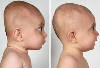 Bẹp Đầu Ở Trẻ Dưới 3 Tháng