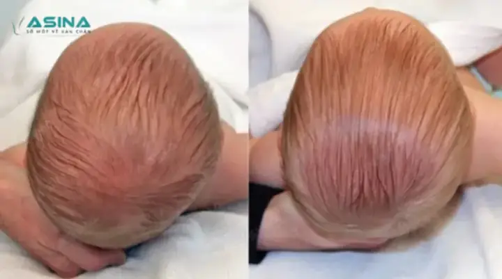 Bẹp Đầu Ở Trẻ Dưới 3 Tháng