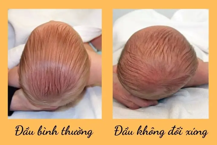 Bẹp Đầu Ở Trẻ Dưới 3 Tháng