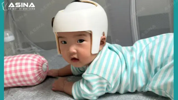 Bẹp Đầu Ở Trẻ Dưới 3 Tháng
