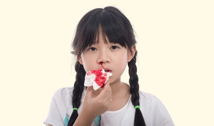 Bị Chảy Máu Cam Nên Uống Gì