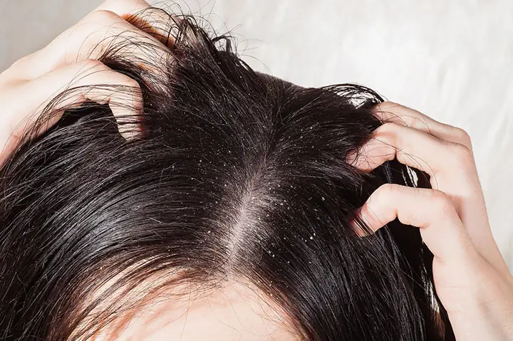 Bị Dị Ứng Dầu Gội Phải Làm Sao