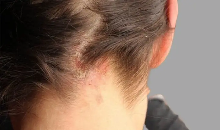 Bị Dị Ứng Dầu Gội Phải Làm Sao