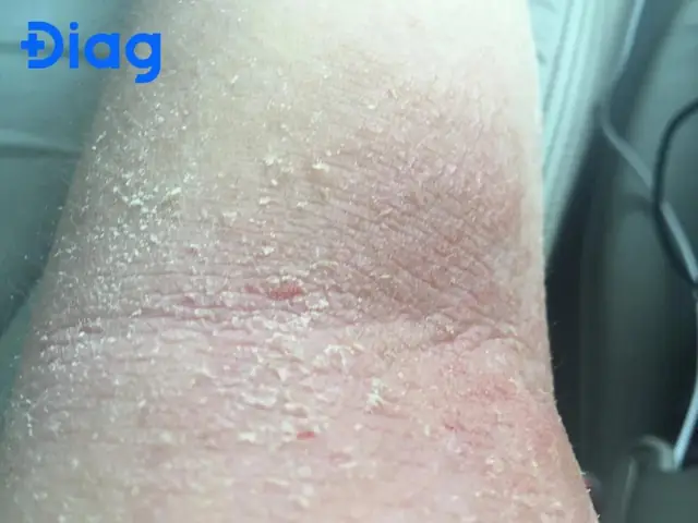 Bị Dị Ứng Khi Mang Thai
