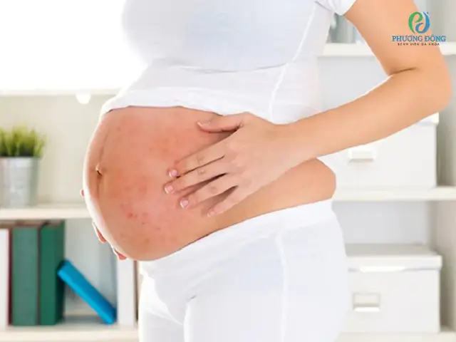 Bị Dị Ứng Khi Mang Thai