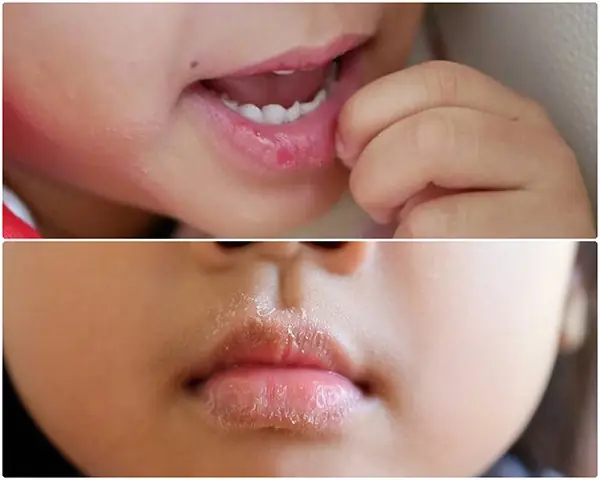 Bị Khô Môi Phải Làm Sao