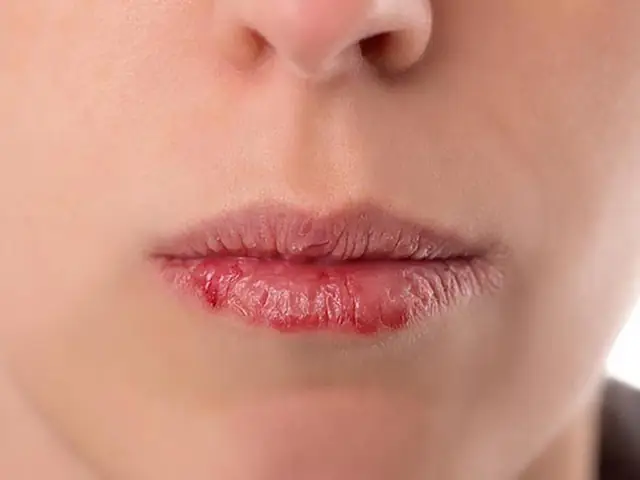 Bị Khô Môi Phải Làm Sao