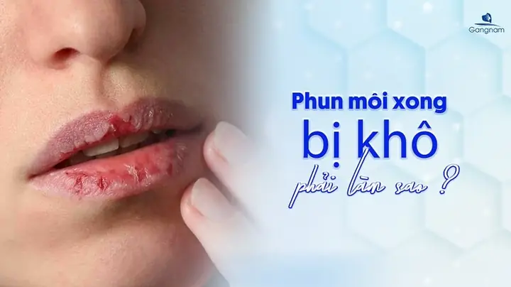 Bị Khô Môi Phải Làm Sao