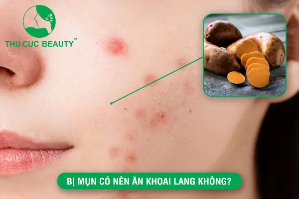 Bị Mụn Có Nên Ăn Khoai Lang Không