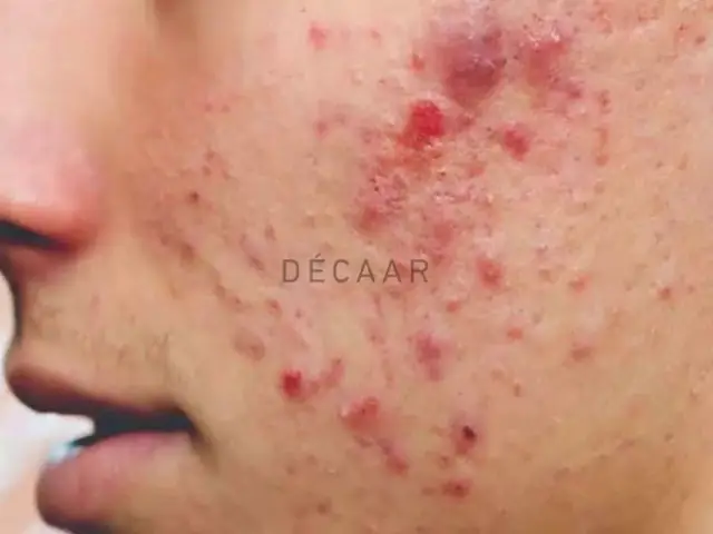 Bị Mụn Có Nên Đắp Mặt Nạ Không