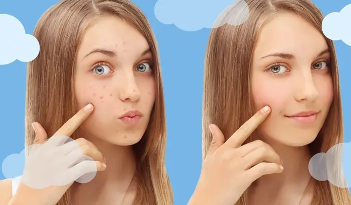 Bị Mụn Có Nên Đắp Mặt Nạ Không