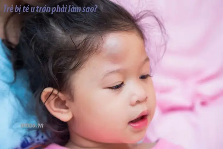 Bị U Đầu Phải Làm Sao
