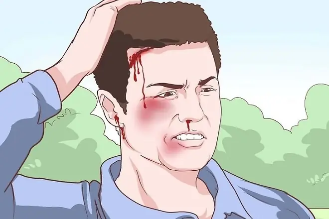 Bị U Đầu Phải Làm Sao